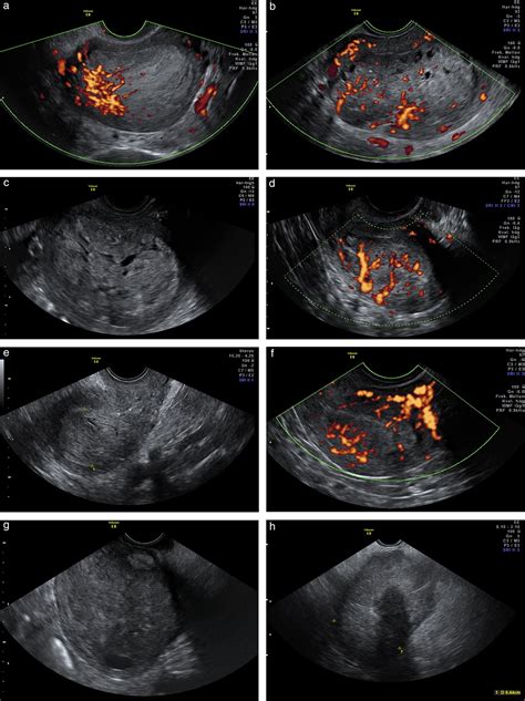 can ultrasound diagnose endometriosis